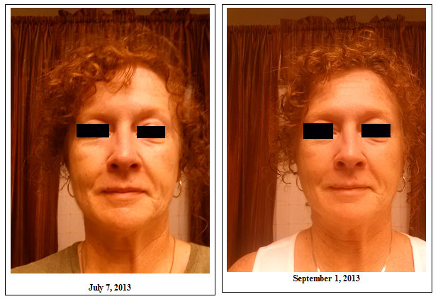 sharon full face before and after photos